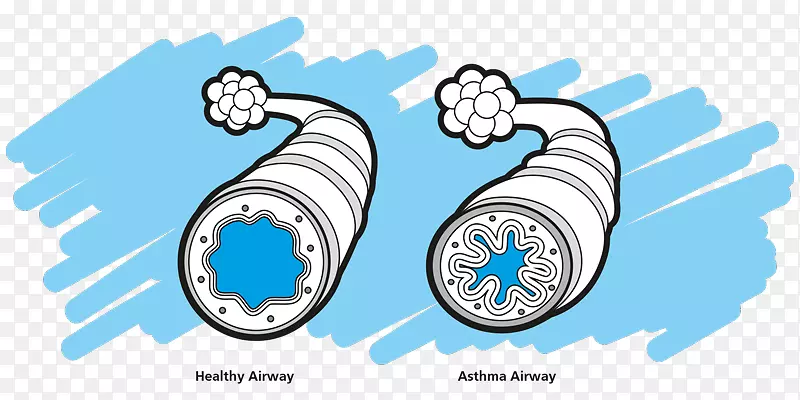 哮喘间隔护理计划疾病剪辑艺术-哮喘