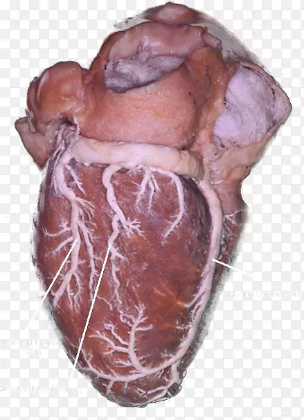 小心脏静脉、心脏冠状窦、大心脏静脉-开放室间隔成形术