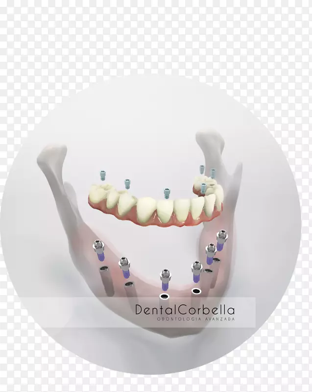 人牙种植体牙科义齿.牙齿种植体