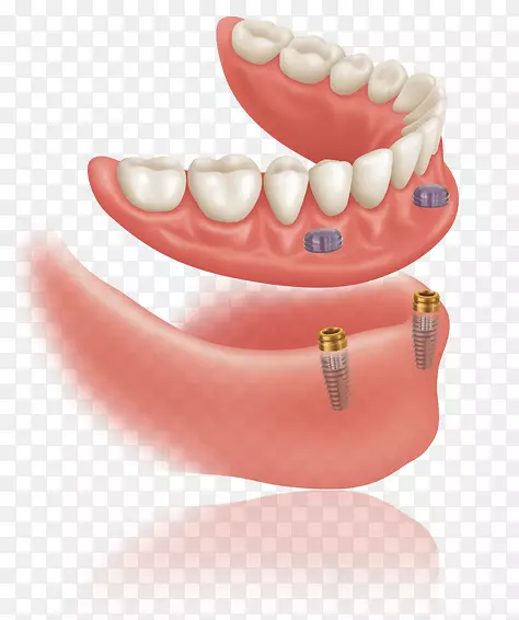 牙科种植义齿