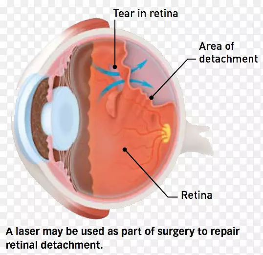玻璃体后脱离视网膜脱离玻璃体漂浮激光手术