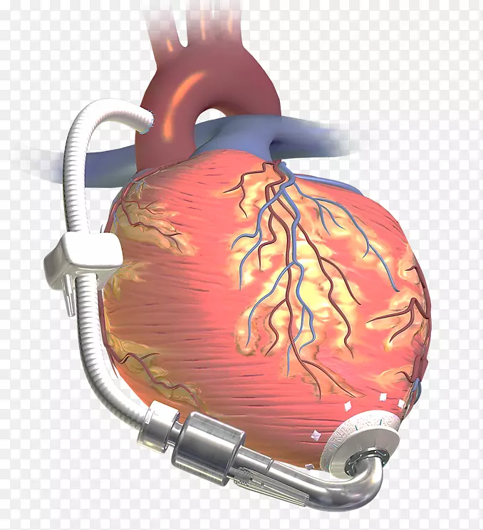 心室辅助装置心脏移植人工心脏五金泵心脏