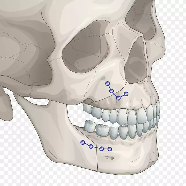 颌骨正颌外科下巴整形手术-面部