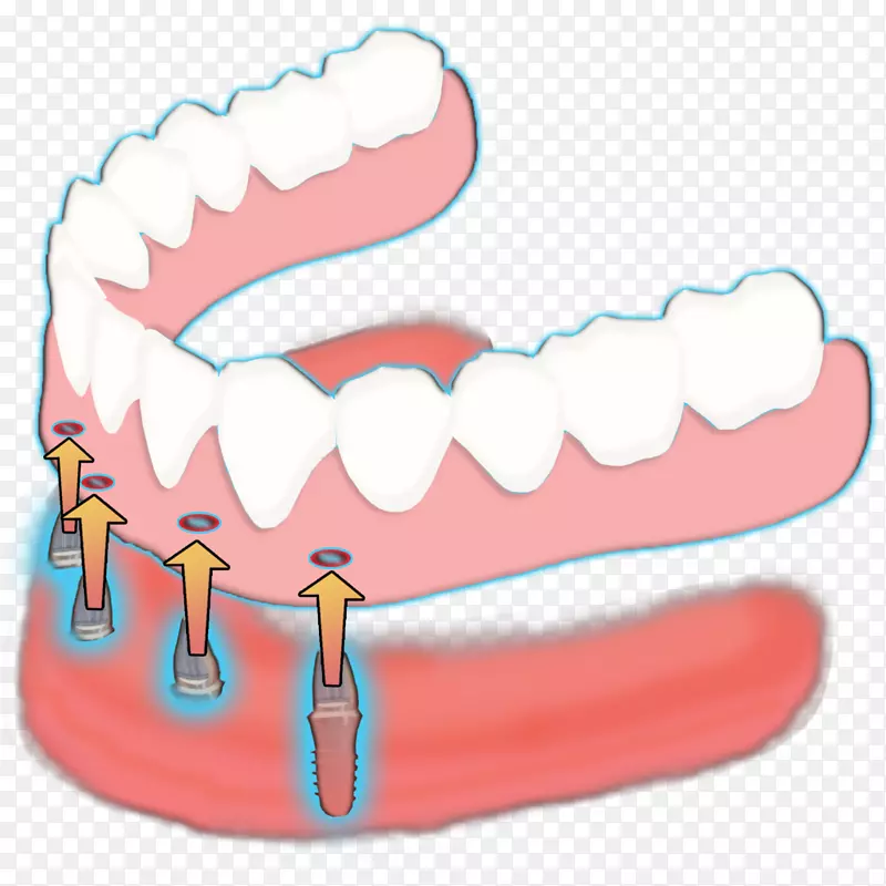牙齿微型种植体：全口义齿的原理和实践.第2部分：钢轨牙