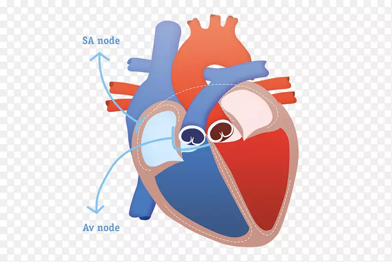 心脏皮下植入除颤器，心脏骤停，心脏猝死，植入式心脏复律器-除颤器-心脏