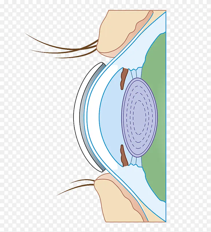 戴隐形眼镜的眼睛分解图