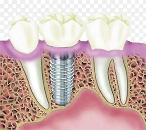 种植牙齿