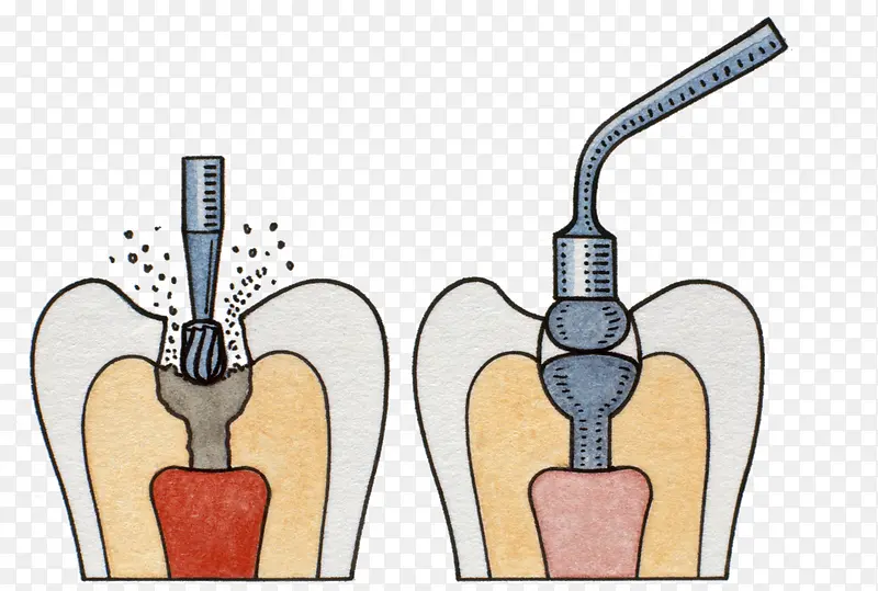 牙根手术插图