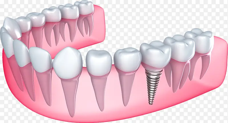 卡通种植牙模型