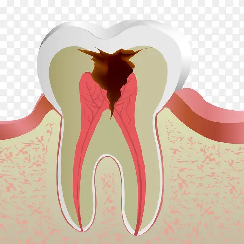 蛀牙牙痛坡面图