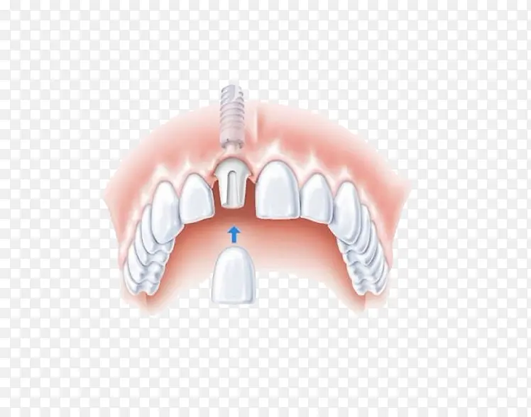 种植牙示意图